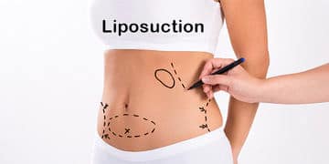 Liposuction nedir? Yağ aldırma ameliyatı nasıl yapılır, riskli midir?
