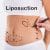Liposuction nedir? Yağ aldırma ameliyatı nasıl yapılır, riskli midir?