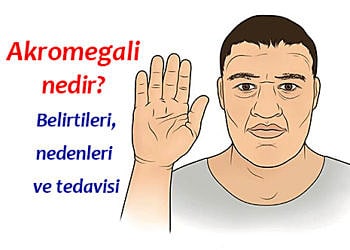 Akromegali nedir, neden olur? Belirtileri ve tedavisi