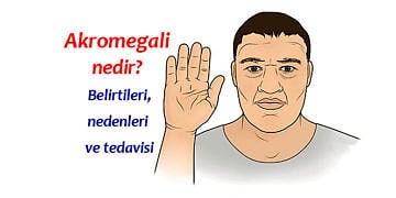 Akromegali nedir, neden olur? Belirtileri ve tedavisi