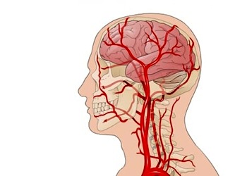Anevrizma nedir? Neden olur? Belirtileri ve tedavi yöntemleri