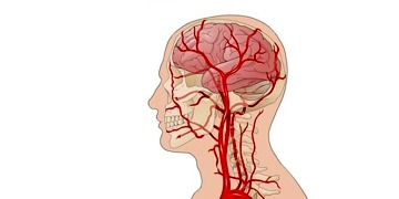 Anevrizma nedir? Neden olur? Belirtileri ve tedavi yöntemleri