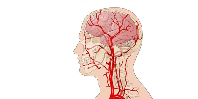 Iskemi Nedir Iskemik Atak Neden Olur Belirtileri Ve Tedavisi