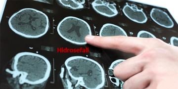Hidrosefali nedir, neden olur? Belirtileri, tedavisi ve ameliyatı