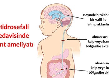 Hidrosefali nedir, neden olur? Belirtileri, tedavisi ve ameliyatı