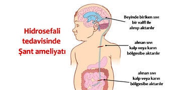 Hidrosefali nedir, neden olur? Belirtileri, tedavisi ve ameliyatı
