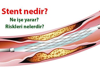 Stent nedir? Kimlere, nasıl takılır? Faydaları ve riskleri