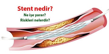 Stent nedir? Kimlere, nasıl takılır? Faydaları ve riskleri