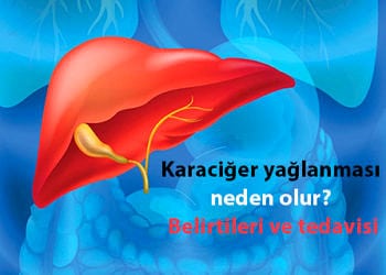 Karaciğer yağlanması neden olur? Belirtileri ve tedavisi