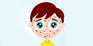 Aşı karşıtlığı kızamık salgınına yol açtı! Hastalık son 3 ayda %300 arttı