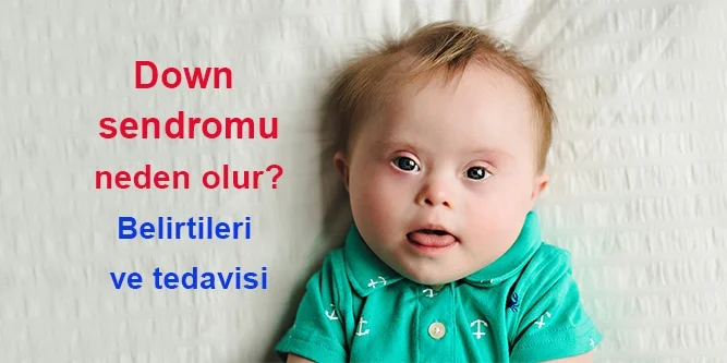 Down Sendromu Nedir Neden Olur Belirtileri Ve Tedavisi