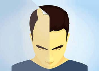 FUE tipi saç ekimi: Nasıl yapılır? Ne kadar sürer? Fiyatı nedir?