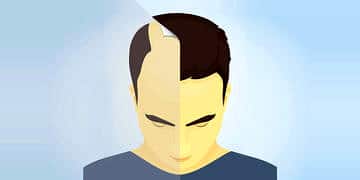 FUE tipi saç ekimi: Nasıl yapılır? Ne kadar sürer? Fiyatı nedir?