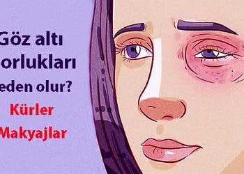 Göz altı morlukları neden olur? Göz morluğuna ne iyi gelir?