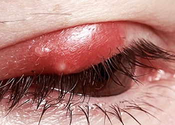 Arpacık nedir, nasıl geçer? Nedenleri, belirtileri ve tedavisi