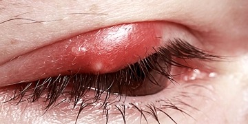 Arpacık nedir, nasıl geçer? Nedenleri, belirtileri ve tedavisi