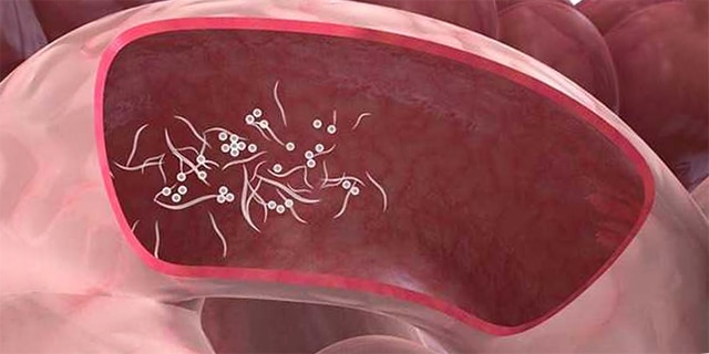 enterobiasis nedir mit kell tenni, ha a papilloma kijön