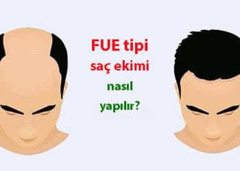 FUE tipi saç ekimi: Nasıl yapılır? Ne kadar sürer? Fiyatı nedir?