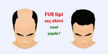 FUE tipi saç ekimi: Nasıl yapılır? Ne kadar sürer? Fiyatı nedir?