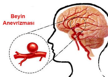 Anevrizma nedir? Neden olur? Belirtileri ve tedavi yöntemleri