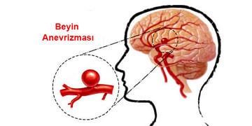 Anevrizma nedir? Neden olur? Belirtileri ve tedavi yöntemleri