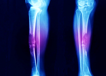 Kemik kanseri neden olur? Belirtileri, evreleri ve tedavi yöntemleri