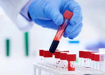Kanser, kan tahlili ile saptanabilir mi? Kanser tarama testleri