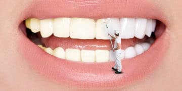 Porselen diş kaplama nedir? Lamina tedavisi nasıl yapılır?
