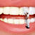 Porselen diş kaplama nedir? Lamina tedavisi nasıl yapılır?