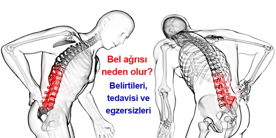 bel agrisi nedir neden olur belirtileri ve tedavi yontemleri