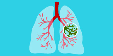 Kistik fibrozis nedir, neden olur? Belirtileri ve tedavisi