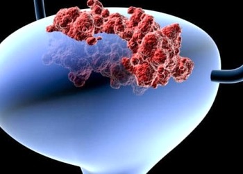 Mesane kanseri nedir? Nasıl tedavi edilir?