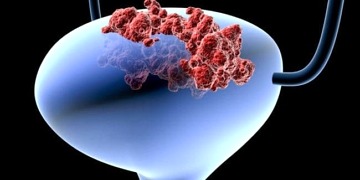 Mesane kanseri nedir? Nasıl tedavi edilir?