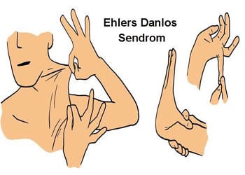 Genetik Hastalıklar: Ehlers Danlos Sendrom(EDS) nedir? Belirtileri ve tedavisi