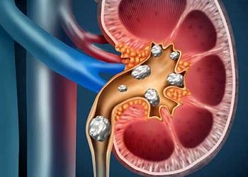 Böbrek Taşı neden olur? Belirtileri nelerdir?