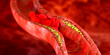 Hiperlipidemi nedir? Neden olur? Belirtileri ve tedavisi