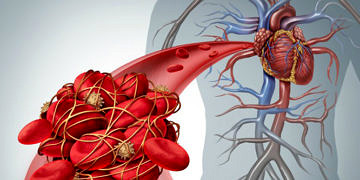 Tromboz nedir? Belirtileri ve tedavisi