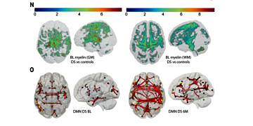 Hormon tedavisi, Down sendromlularda zihinsel iyileştirme sağlıyor