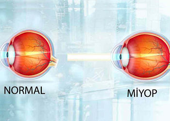 Miyop neden olur? Belirtileri ve güncel tedavi seçenekleri