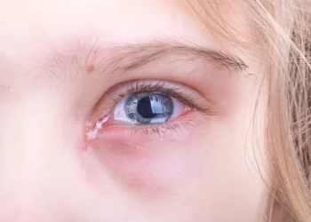 Göz Alerjisi Neden Olur? Belirtileri, Nedenleri ve Tedavisi