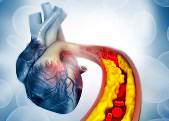 Kolesterolü yükselten nedenler ve düşürme yolları