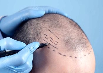 2024 Türkiye’deki En İyi 20 Saç Ekimi Merkezi Ve Saç Ekim Fiyatları