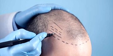 2024 Türkiye’deki En İyi 20 Saç Ekimi Merkezi Ve Saç Ekim Fiyatları