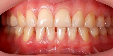 Diş Eti Çekilmesi Neden Olur, Ne İyi Gelir?