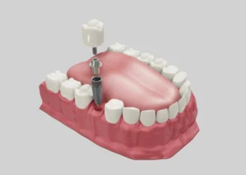 Tam Ağız İmplant Tedavisi (All-on-4 / All-on-6) Uygulamalarında Klinik Yaklaşım