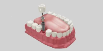 Tam Ağız İmplant Tedavisi (All-on-4 / All-on-6) Uygulamalarında Klinik Yaklaşım