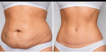 Karın Germe ve Liposuction: Doğru Doktoru Seçmek ve Süreci Anlamak