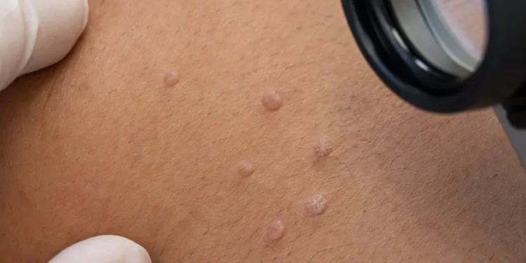Genital siğilde lazer mi, kriyoterapi mi? Tedavi seçimini gerçekten ne belirliyor?